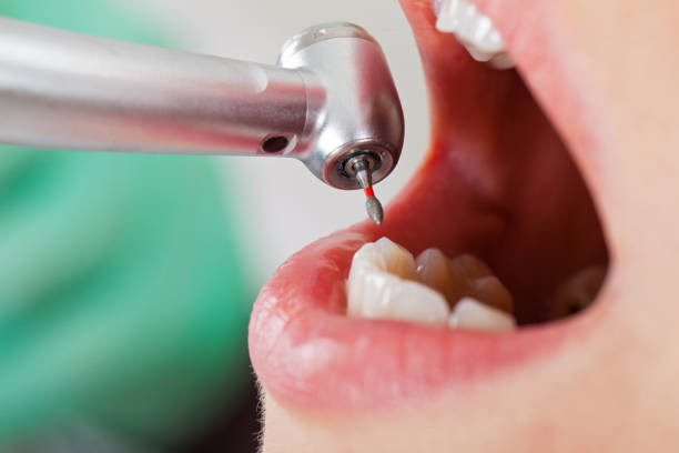 Best Emergency Tooth Extraction in Paincourtville, LA
